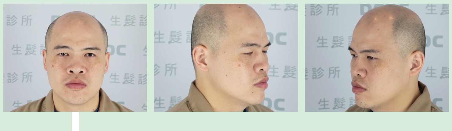 DCDC專業植鬍前完全看不到鬍子